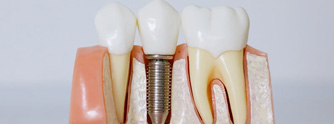 Implantes Dentários